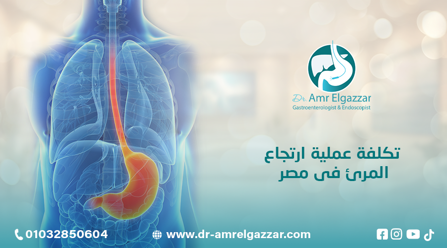 تكلفة عملية ارتجاع المرئ فى مصر