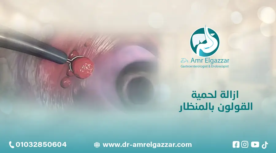 ازالة لحمية القولون بالمنظار