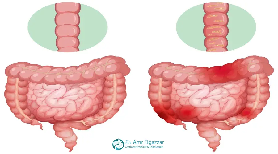 ازالة لحمية القولون بالمنظار 