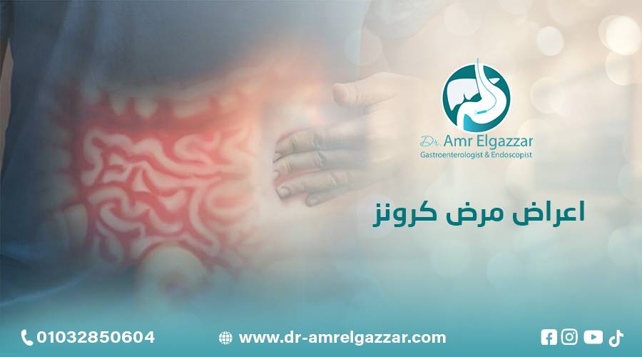 اعراض مرض كرونز