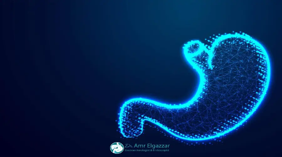 علاج ارتجاع المرئ بالمنظار 