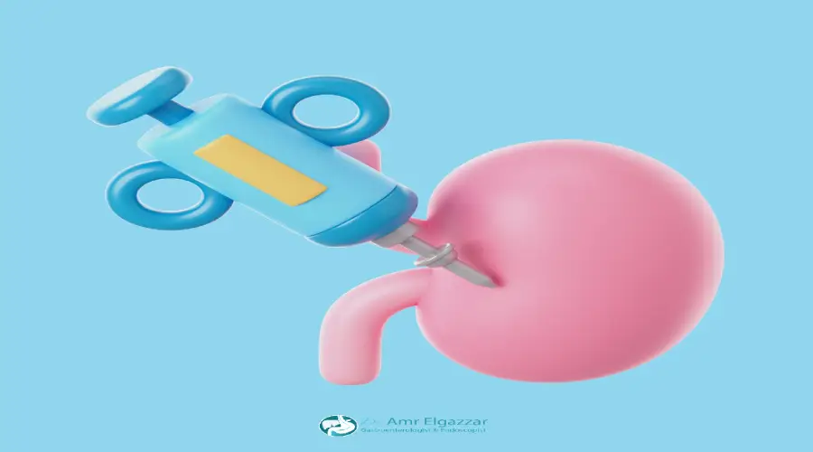 علاج ارتجاع المرئ بالمنظار