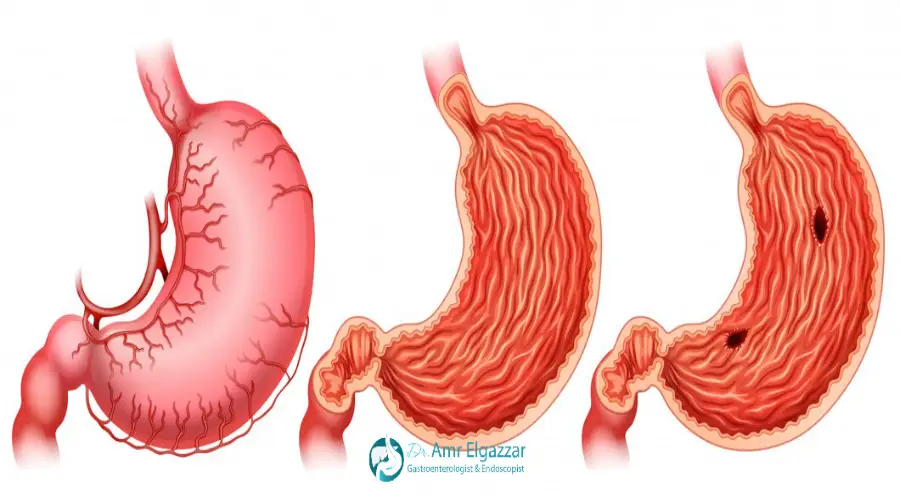 علاج ارتجاع المرئ
