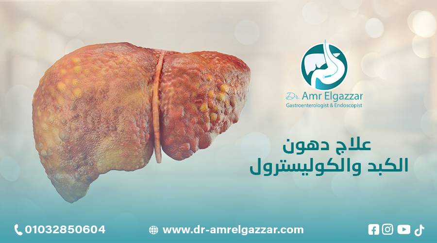 علاج دهون الكبد والكوليسترول