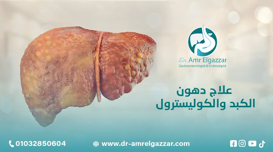 علاج دهون الكبد والكوليسترول