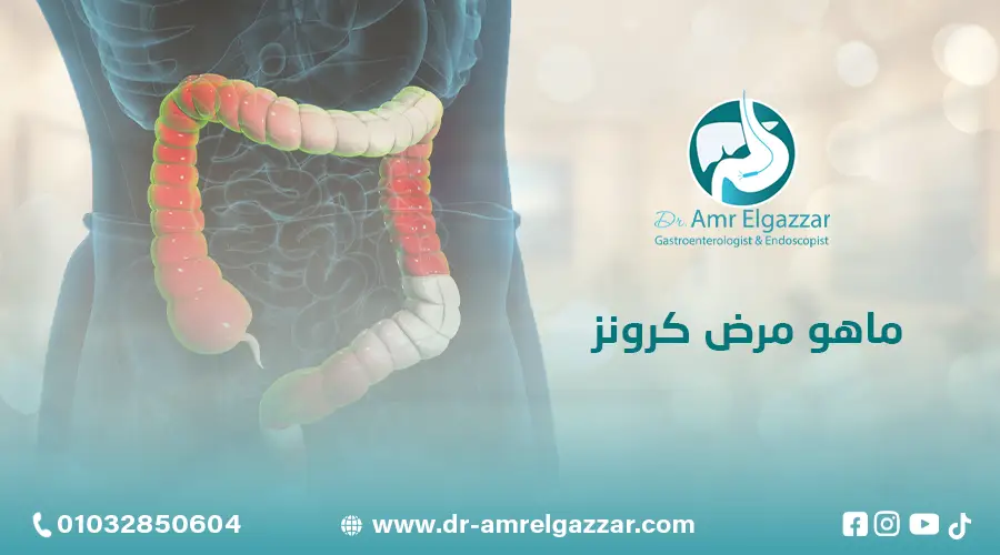 ماهو مرض كرونز