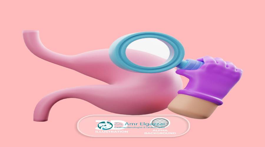 منظار ارتجاع المريء