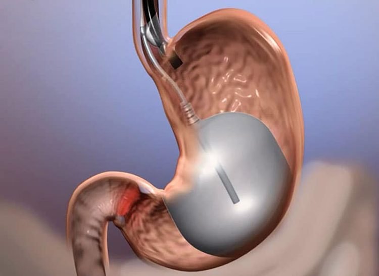 gastric balloon procedure